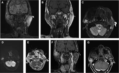 A case report of parotid gland epithelioid hemangioendothelioma